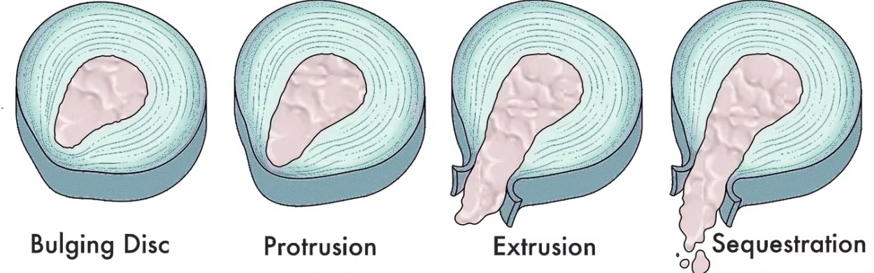 Rappresentazione anatomica di Ernia del Disco e Protrusione
